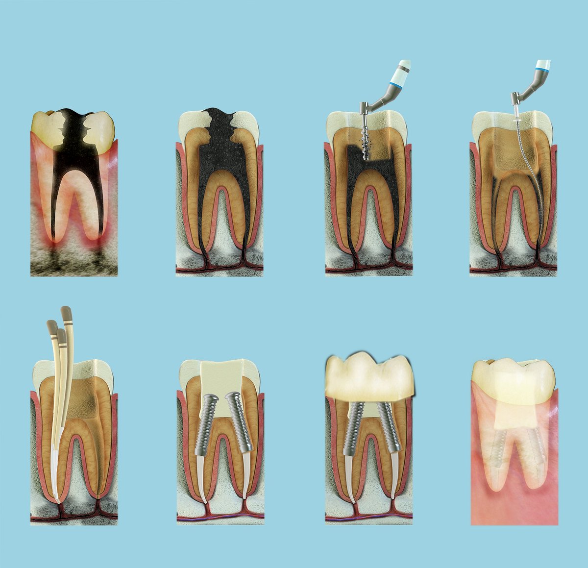 Root canal dentist Robina - dental procedure stages