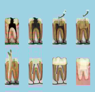 Root canal dentist Robina