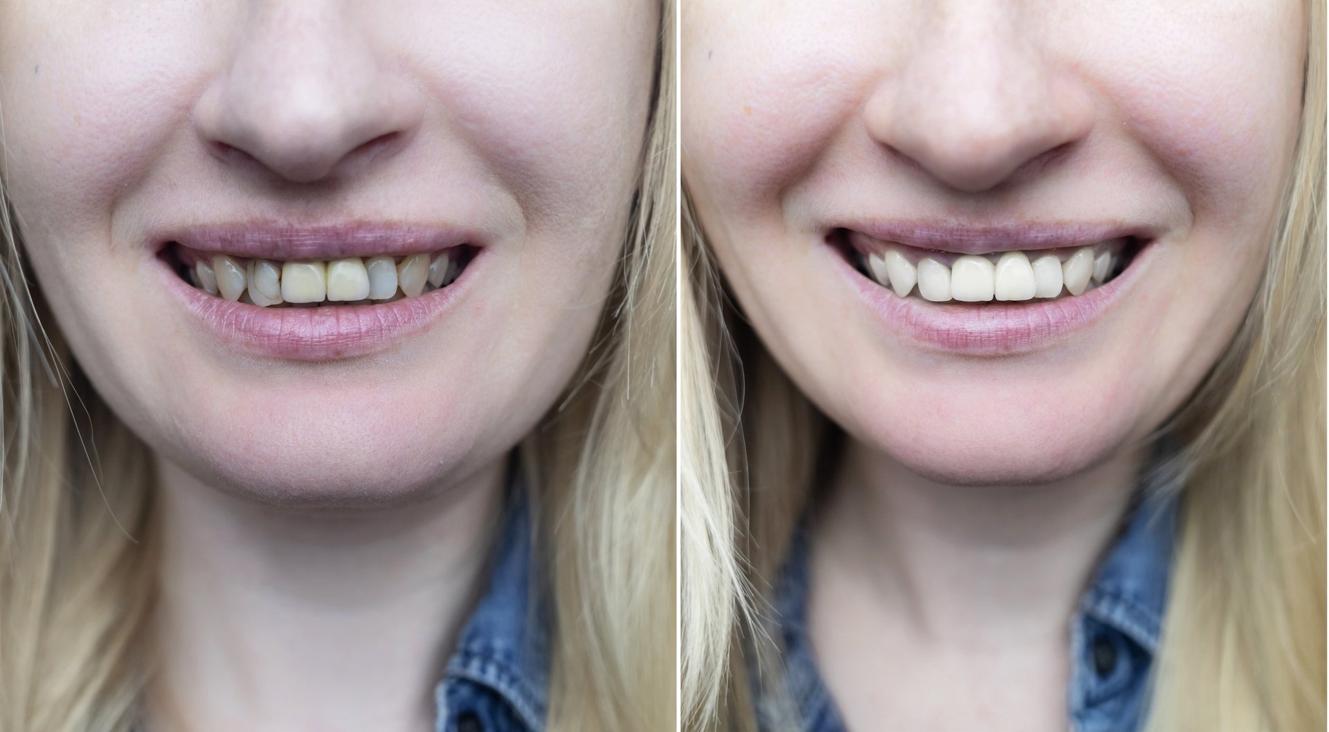 Successful restoration of front incisors. Tooth build-up and reconstruction for a healthy smile. High-quality before and after photos of artistic dental restoration.