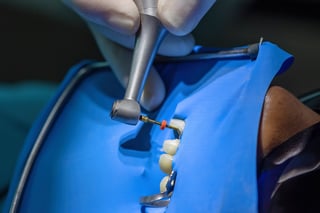 Root canal treatment Robina