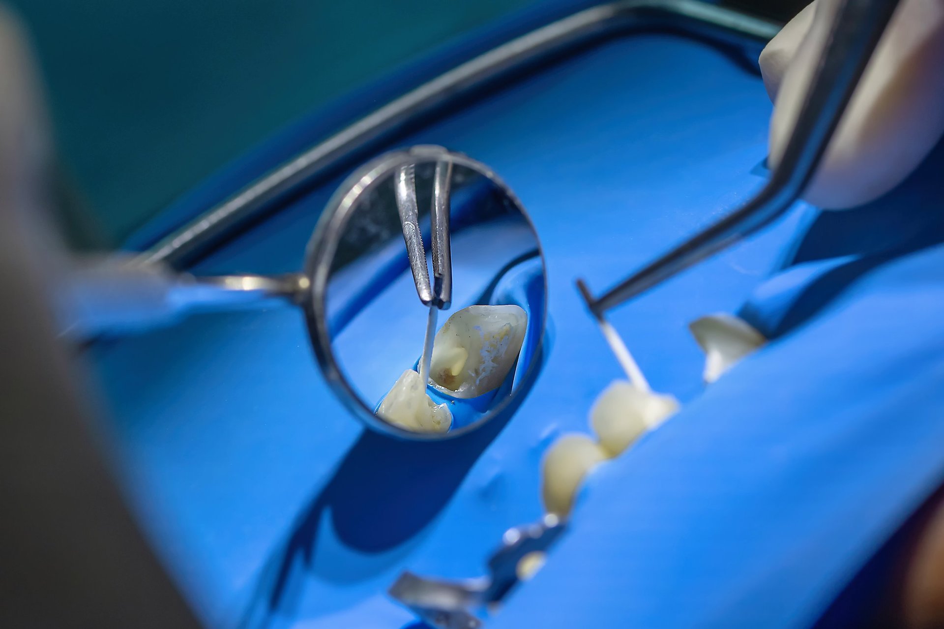 Detailed view of a dentist performing root canal treatment using a rubber dam, mirror, and precision instruments for professional dental care.