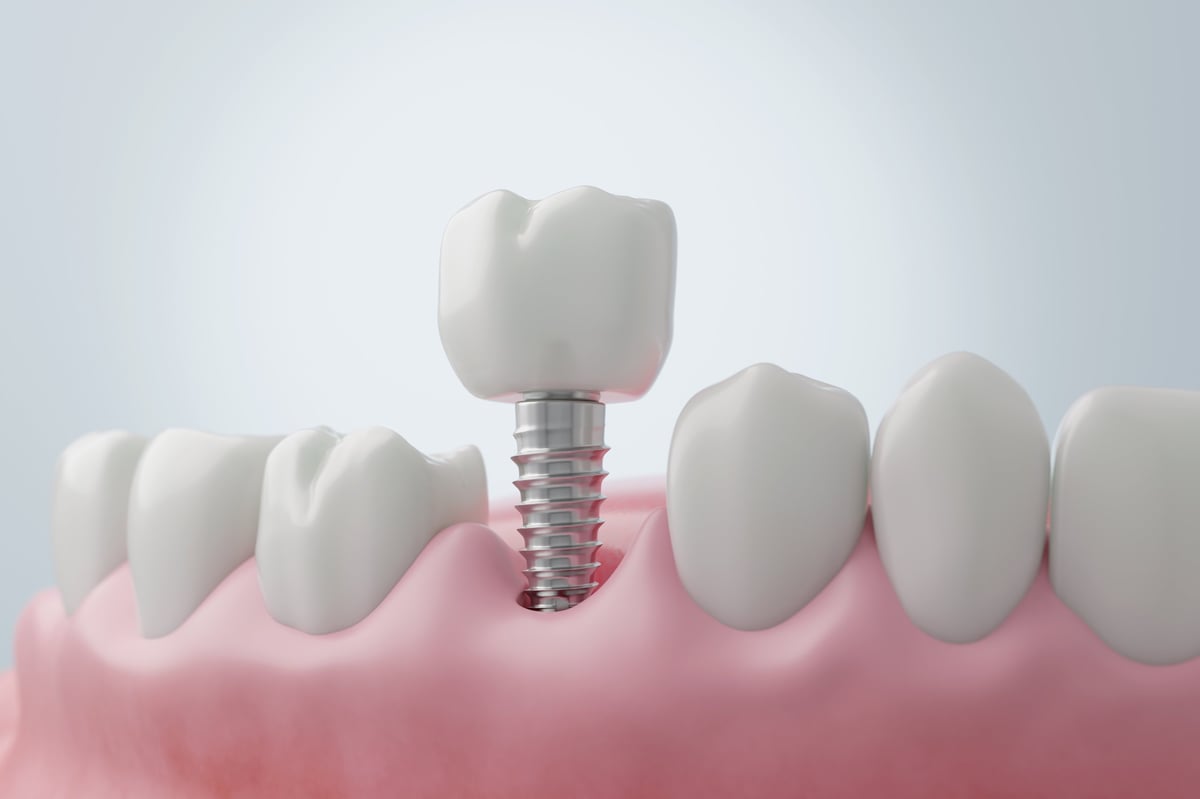Titanium dental implant installation for a molar tooth replacement, showing the screw placed in the jawbone for oral restoration. 3D render.