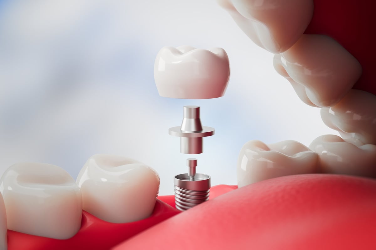 Dental implant parts including crown, abutment, and screw inside open mouth, realistic 3D Rendering