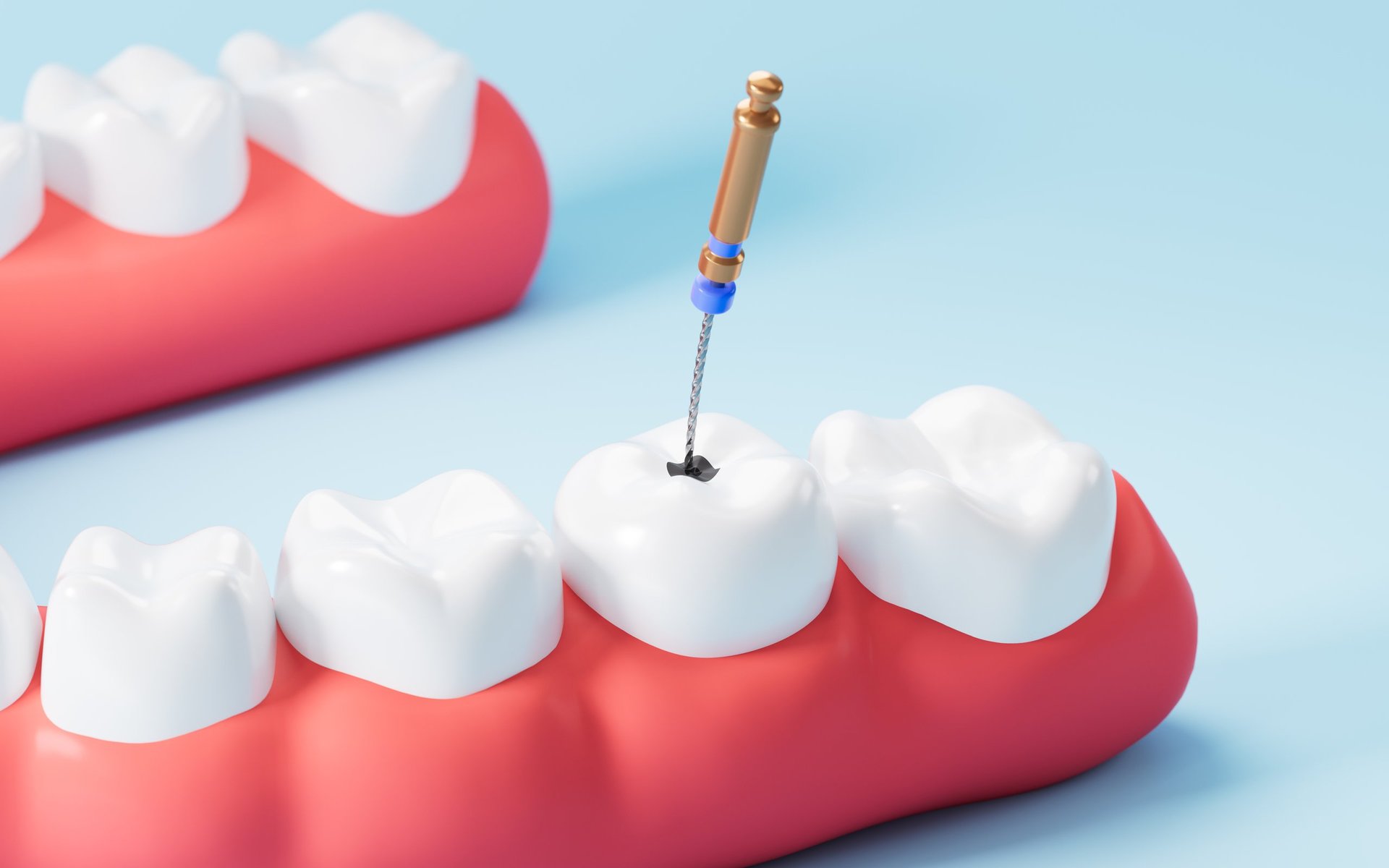 Human teeth root canal treatment process. 3d rendering. 3d illustration.